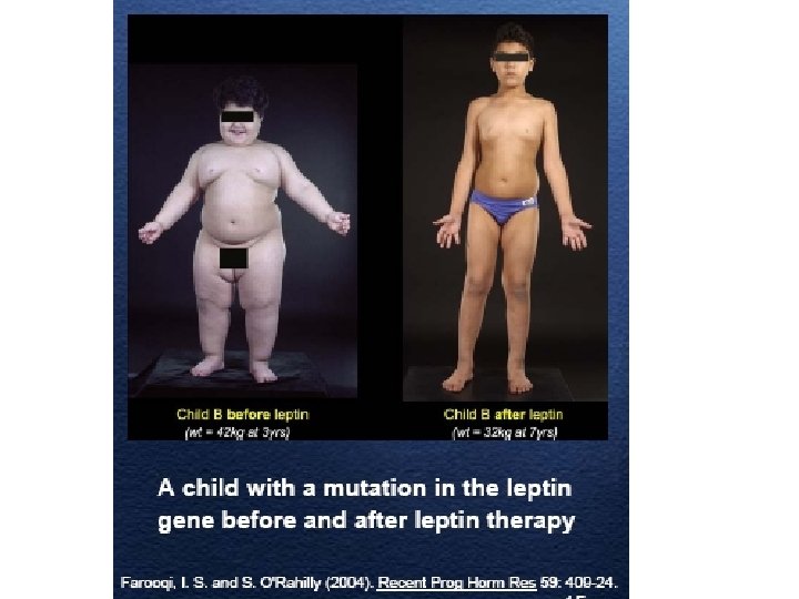 Leptin Treatment 