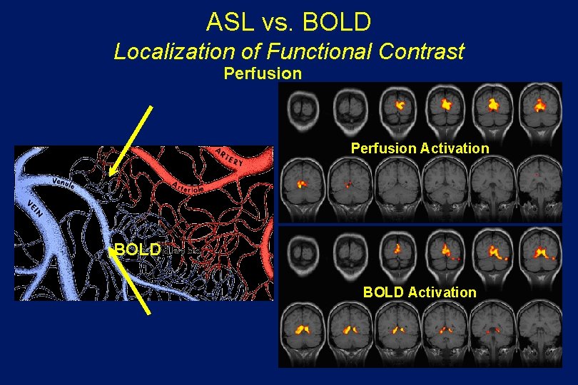 ASL vs. BOLD Localization of Functional Contrast Perfusion Activation BOLD Activation 