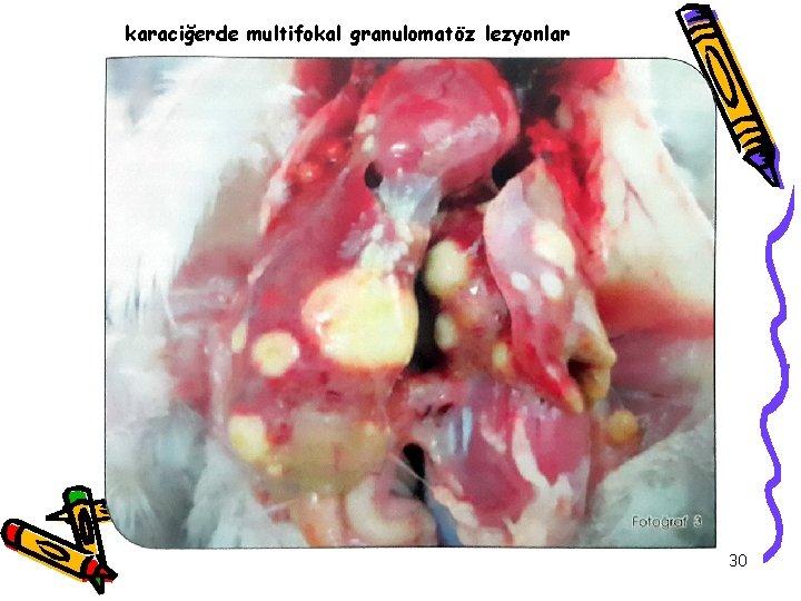 karaciğerde multifokal granulomatöz lezyonlar 30 