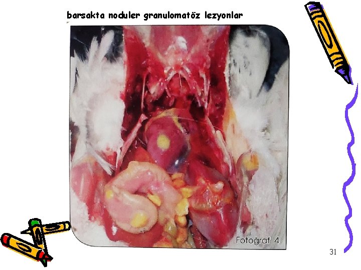 barsakta noduler granulomatöz lezyonlar 31 