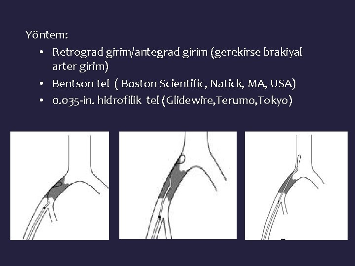 Yöntem: • Retrograd girim/antegrad girim (gerekirse brakiyal arter girim) • Bentson tel ( Boston