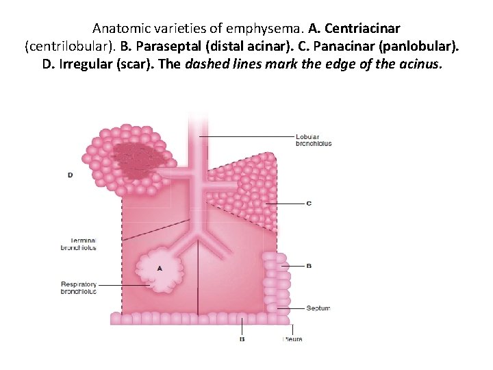 Anatomic varieties of emphysema. A. Centriacinar (centrilobular). B. Paraseptal (distal acinar). C. Panacinar (panlobular).