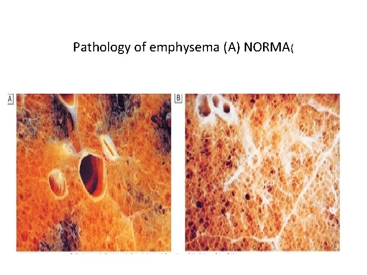 Pathology of emphysema (A) NORMA( 