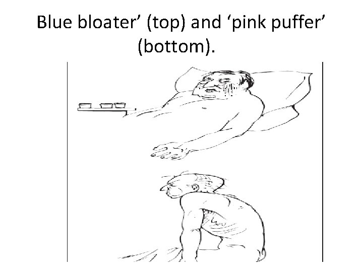 Blue bloater’ (top) and ‘pink puffer’ (bottom). 