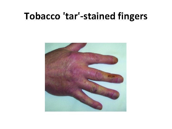 Tobacco 'tar'-stained fingers 