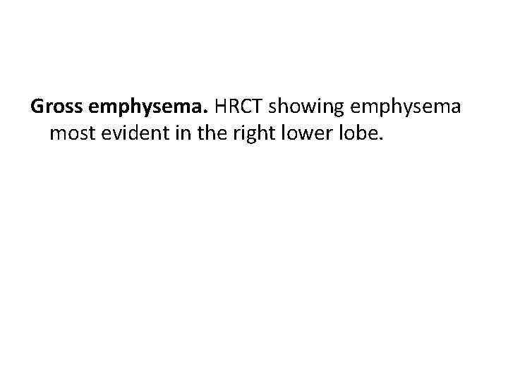 Gross emphysema. HRCT showing emphysema most evident in the right lower lobe. 