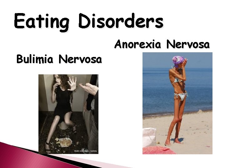 Eating Disorders Bulimia Nervosa Anorexia Nervosa 