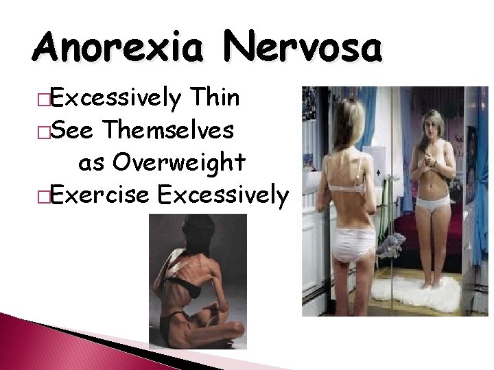 Anorexia Nervosa �Excessively Thin �See Themselves as Overweight �Exercise Excessively 