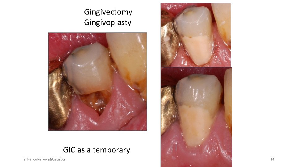 Gingivectomy Gingivoplasty GIC as a temporary lenka. roubalikova@tiscali. cz 14 
