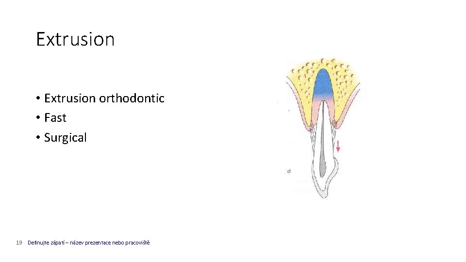 Extrusion • Extrusion orthodontic • Fast • Surgical 19 Definujte zápatí – název prezentace