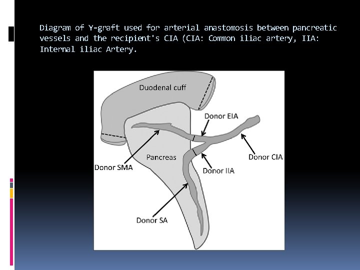 Diagram of Y-graft used for arterial anastomosis between pancreatic vessels and the recipient's CIA