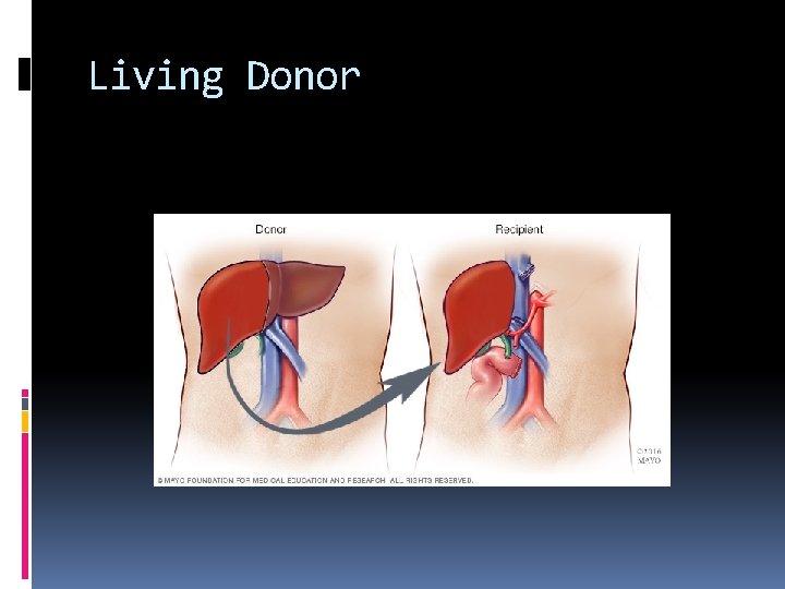 Living Donor 