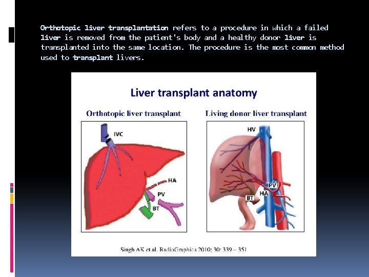 Orthotopic liver transplantation refers to a procedure in which a failed liver is removed