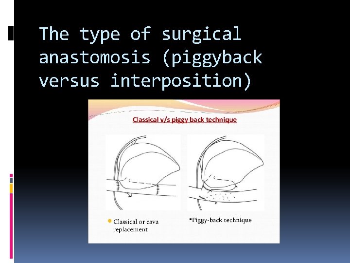 The type of surgical anastomosis (piggyback versus interposition) 
