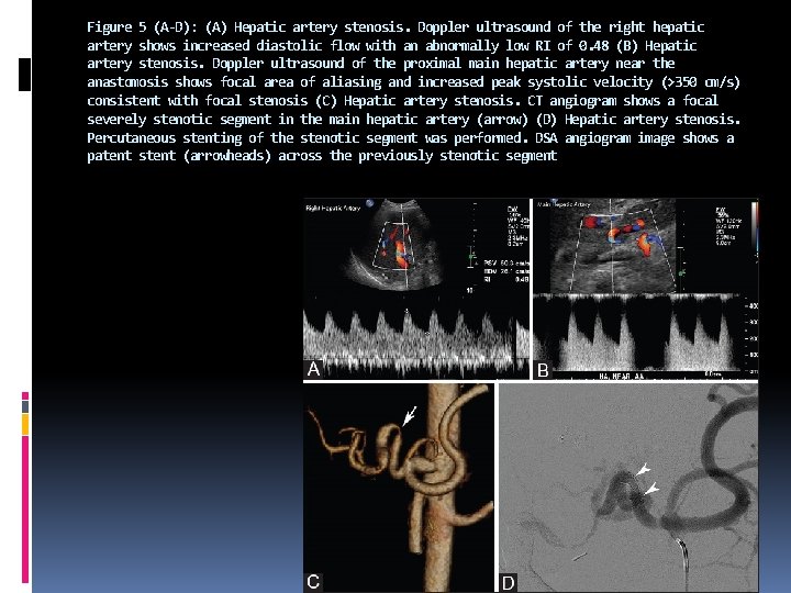 Figure 5 (A-D): (A) Hepatic artery stenosis. Doppler ultrasound of the right hepatic artery