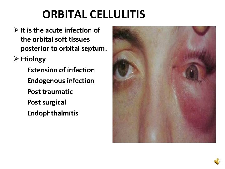 ORBITAL CELLULITIS Ø It is the acute infection of the orbital soft tissues posterior