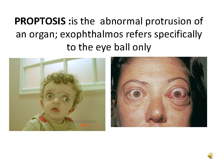 PROPTOSIS : is the abnormal protrusion of an organ; exophthalmos refers specifically to the