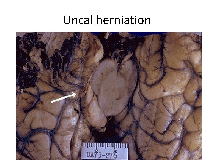 Uncal herniation 