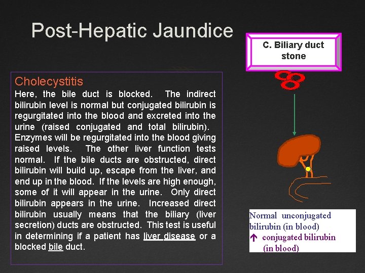 Post-Hepatic Jaundice C. Biliary duct stone Cholecystitis Here, the bile duct is blocked. The