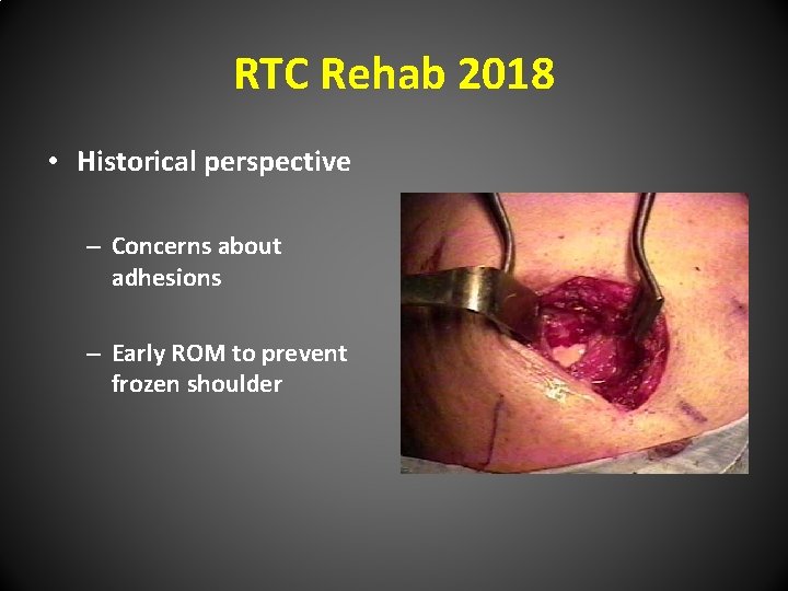 RTC Rehab 2018 • Historical perspective – Concerns about adhesions – Early ROM to