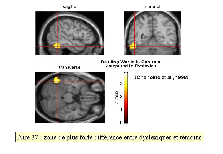 Aire 37 : zone de plus forte différence entre dyslexiques et témoins 