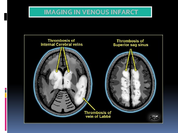 IMAGING IN VENOUS INFARCT 
