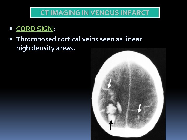 CT IMAGING IN VENOUS INFARCT CORD SIGN: Thrombosed cortical veins seen as linear high