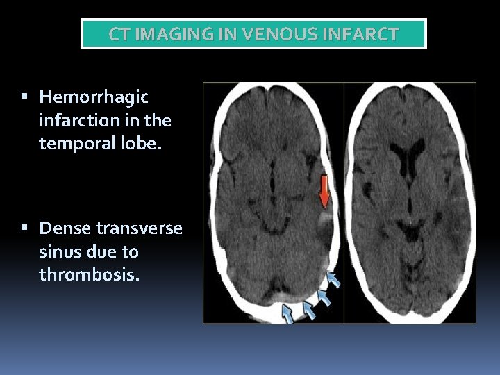 CT IMAGING IN VENOUS INFARCT Hemorrhagic infarction in the temporal lobe. Dense transverse sinus