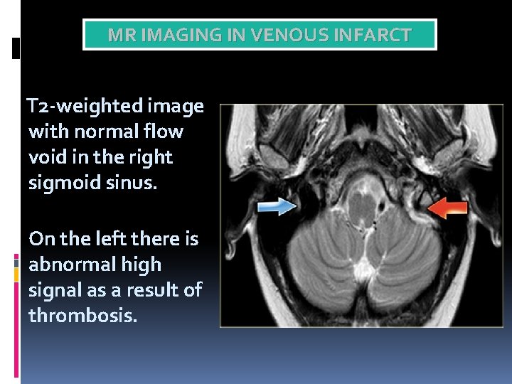 MR IMAGING IN VENOUS INFARCT T 2 -weighted image with normal flow void in