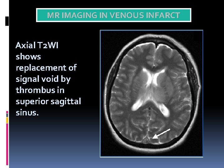 MR IMAGING IN VENOUS INFARCT Axial T 2 WI shows replacement of signal void