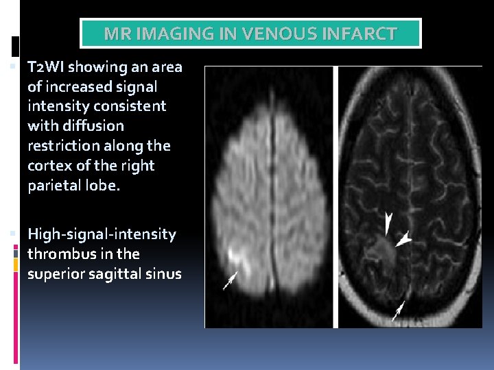 MR IMAGING IN VENOUS INFARCT T 2 WI showing an area of increased signal