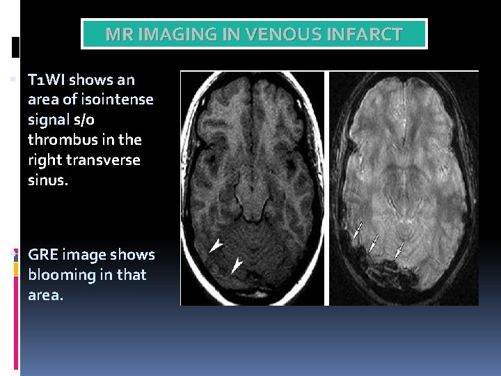MR IMAGING IN VENOUS INFARCT T 1 WI shows an area of isointense signal