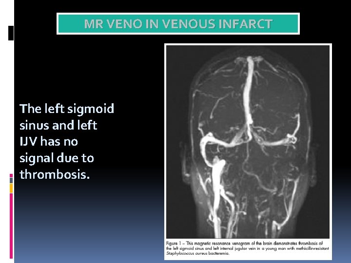 MR VENO IN VENOUS INFARCT The left sigmoid sinus and left IJV has no
