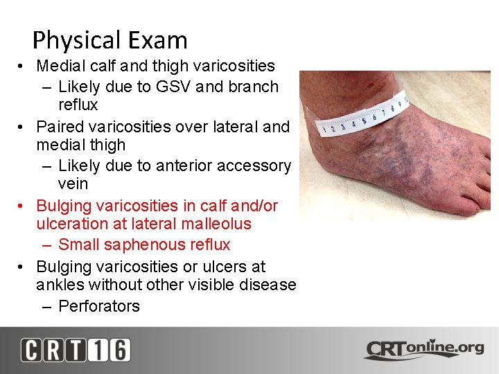 Physical Exam • Medial calf and thigh varicosities – Likely due to GSV and