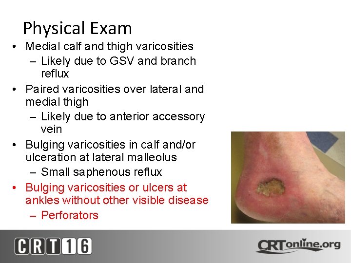 Physical Exam • Medial calf and thigh varicosities – Likely due to GSV and