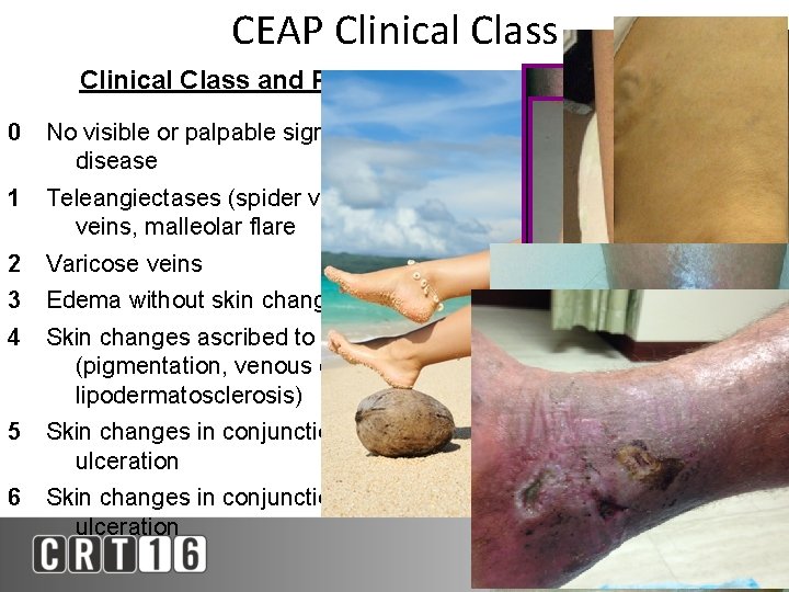 CEAP Clinical Class and Presentation 0 No visible or palpable signs of venous disease