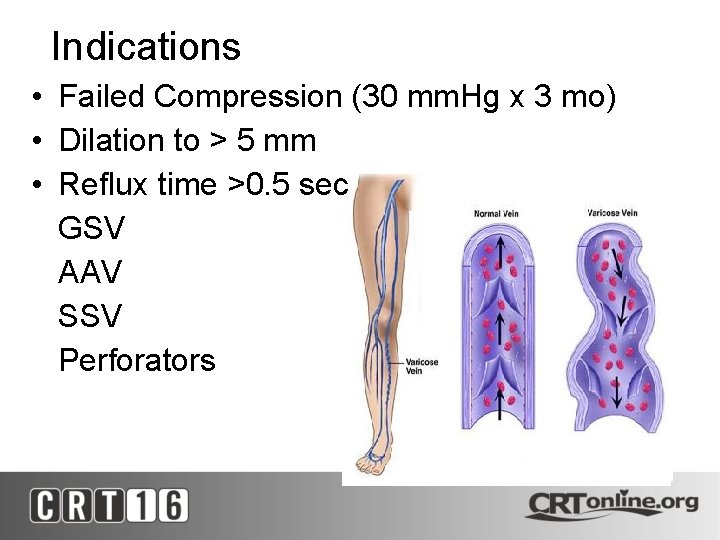 Indications • Failed Compression (30 mm. Hg x 3 mo) • Dilation to >