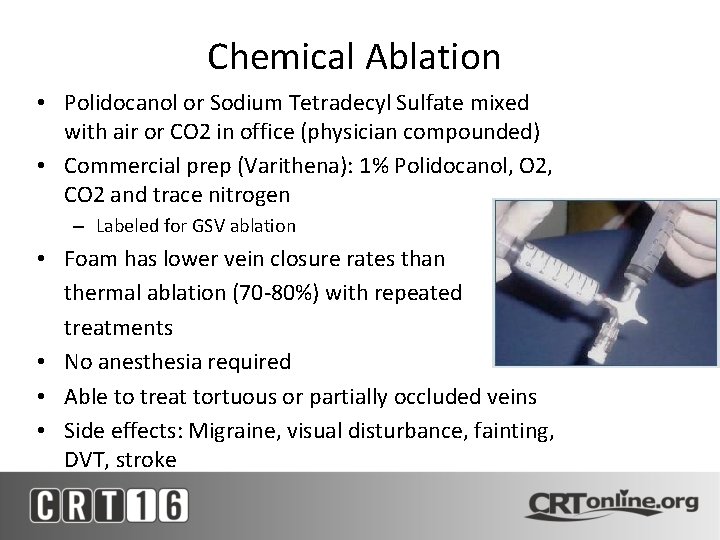 Chemical Ablation • Polidocanol or Sodium Tetradecyl Sulfate mixed with air or CO 2