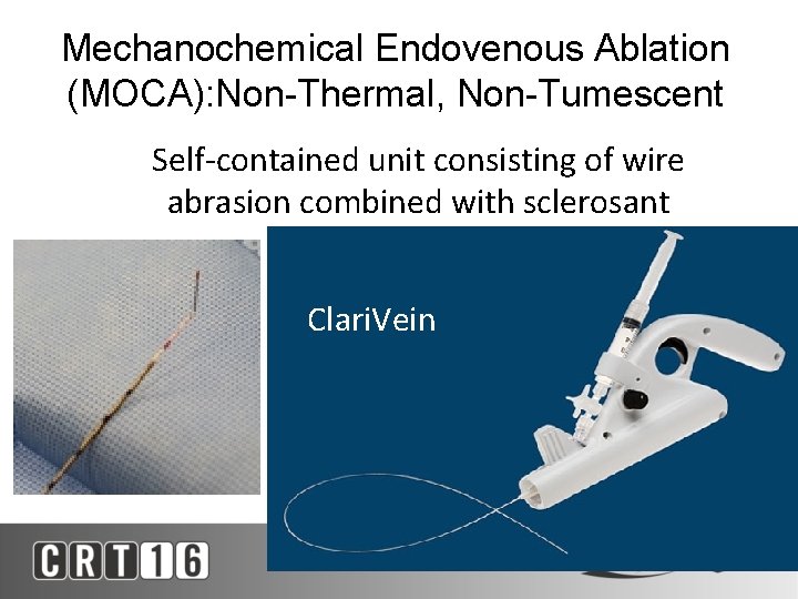 Mechanochemical Endovenous Ablation (MOCA): Non-Thermal, Non-Tumescent Self-contained unit consisting of wire abrasion combined with