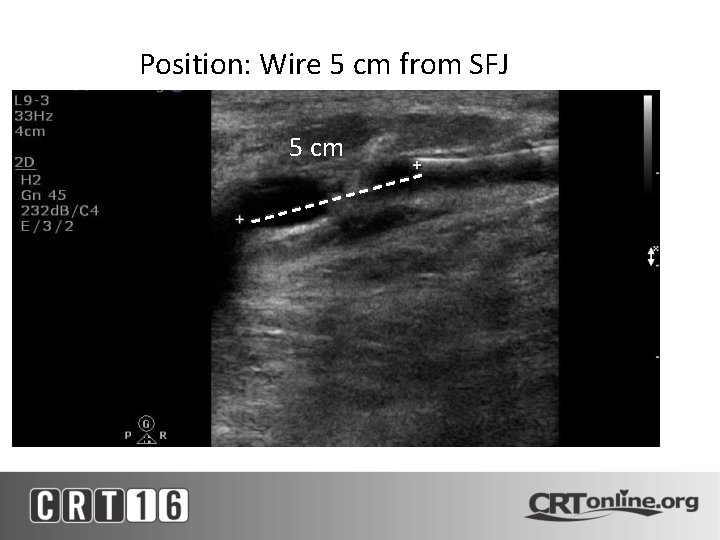 Position: Wire 5 cm from SFJ 5 cm 