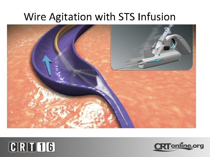 Wire Agitation with STS Infusion 