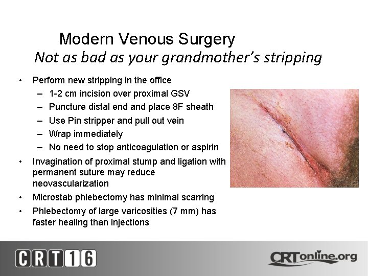 Modern Venous Surgery Not as bad as your grandmother’s stripping • Perform new stripping