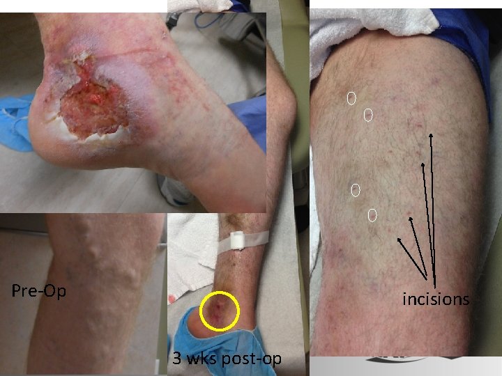 Pre-Op incisions 3 wks post-op 