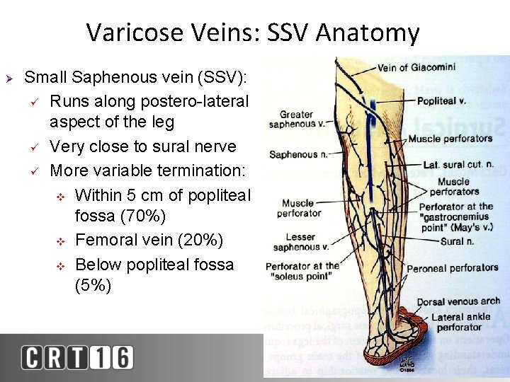 Varicose Veins: SSV Anatomy Ø Small Saphenous vein (SSV): ü Runs along postero-lateral aspect
