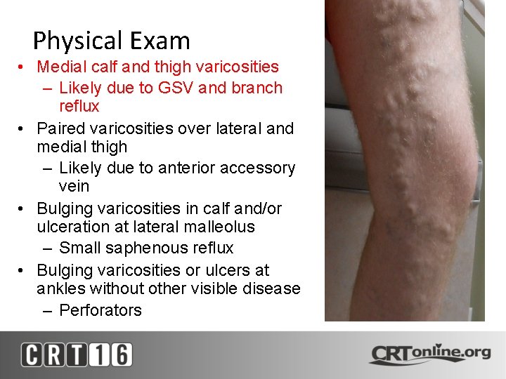 Physical Exam • Medial calf and thigh varicosities – Likely due to GSV and