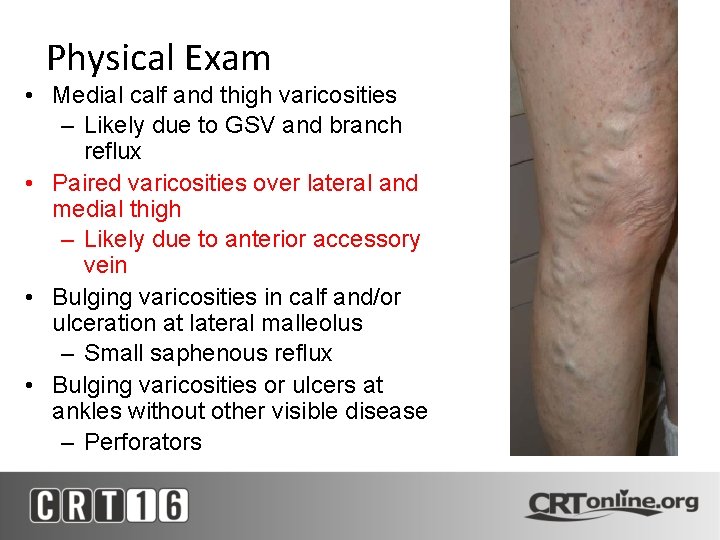 Physical Exam • Medial calf and thigh varicosities – Likely due to GSV and