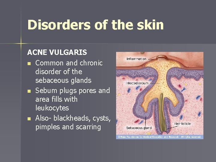 Disorders of the skin ACNE VULGARIS n Common and chronic disorder of the sebaceous