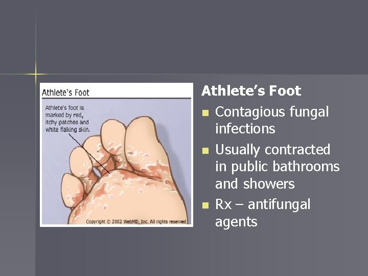 Athlete’s Foot n Contagious fungal infections n Usually contracted in public bathrooms and showers