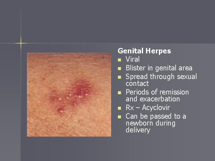 Genital Herpes n Viral n Blister in genital area n Spread through sexual contact