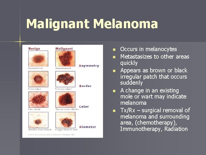 Malignant Melanoma n n n Occurs in melanocytes Metastasizes to other areas quickly Appears